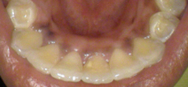 clear aligners ilford