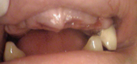 dentures ilford